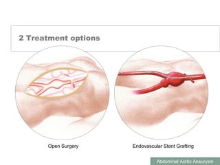 ABDOMINAL AORTIC ANEURYSMS
Abdominal Aortic Aneurysm
2 Treatment options
Endovascular Stent GraftingOpen Surgery
 