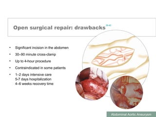 ABDOMINAL AORTIC ANEURYSMS
Abdominal Aortic Aneurysm
Open surgical repair: drawbacks
• Significant incision in the abdomen
• 30–90 minute cross-clamp
• Up to 4-hour procedure
• Contraindicated in some patients
• 1–2 days intensive care
5-7 days hospitalization
4–6 weeks recovery time
39-40
 