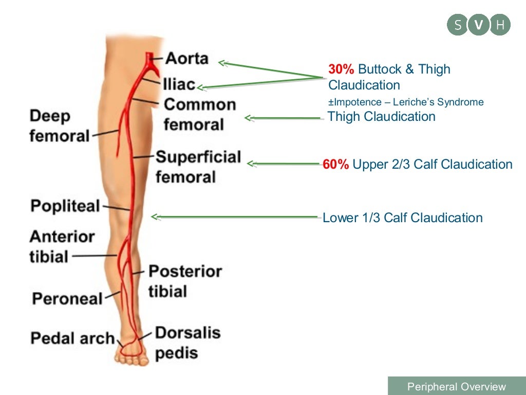 Determining a vascular cause for leg pain and referrals