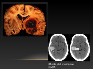 CT može otkriti krvarenje malo i
do 2mm
 