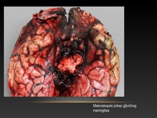 Makroskopski prikaz gljivičnog
meningitisa
 