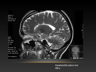 Karakteristički plakovi kod
MS-a
 