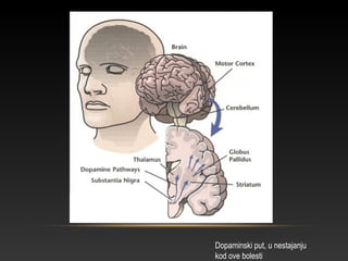 Dopaminski put, u nestajanju
kod ove bolesti
 