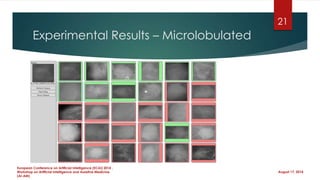 Experimental Results – Microlobulated
August 17, 2014
European Conference on Artificial Intelligence (ECAI) 2014 ,
Workshop on Artificial Intelligence and Assistive Medicine
(AI-AM)
21
 