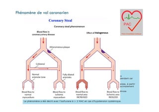 Phénomène de vol coronarien
 