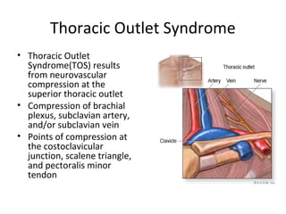 Thoracic Outlet Syndrome
• Thoracic Outlet
Syndrome(TOS) results
from neurovascular
compression at the
superior thoracic outlet
• Compression of brachial
plexus, subclavian artery,
and/or subclavian vein
• Points of compression at
the costoclavicular
junction, scalene triangle,
and pectoralis minor
tendon
 