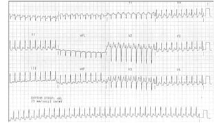 SUPRAVENTRICULAR TACHYCARDIA - SVT | PPTX