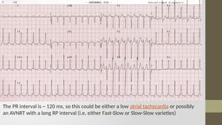 Svt Algorithm Rp Interval All you want to know about SVT in brief .pptx