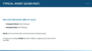 Supraventricular tachycardia presentation.pptx