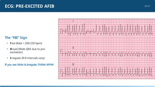 Supraventricular tachycardia presentation.pptx