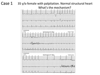 [object Object],35 y/o female with palpitation. Normal structural heart What’s the mechanism?  