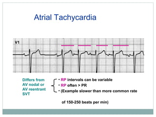 Svt Algorithm Rp Interval Svt and vm | PPT
