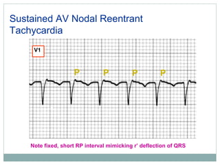 Svt Algorithm Rp Interval Svt and vm | PPT