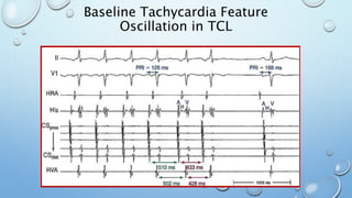 Baseline Tachycardia Feature
Oscillation in TCL
 