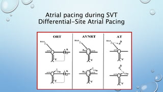 Atrial pacing during SVT
Differential-Site Atrial Pacing
 
