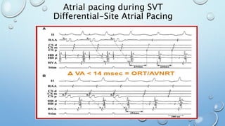 Atrial pacing during SVT
Differential-Site Atrial Pacing
 