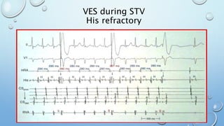 VES during STV
His refractory
 