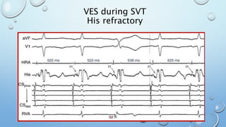 VES during SVT
His refractory
 