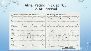 Atrial Pacing in SR at TCL
Δ AH interval
 