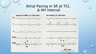 Atrial Pacing in SR at TCL
Δ AH interval
 