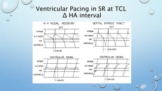 Ventricular Pacing in SR at TCL
Δ HA interval
 