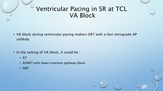 • VA block during ventricular pacing makers ORT with a fast retrograde AP
unlikely
• In the setting of VA block, it could be :
• AT
• AVNRT with lower common pathway block
• PJRT
Ventricular Pacing in SR at TCL
VA Block
 