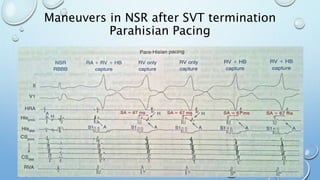 Maneuvers in NSR after SVT termination
Parahisian Pacing
 