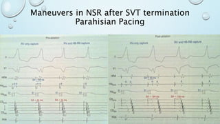 Maneuvers in NSR after SVT termination
Parahisian Pacing
 