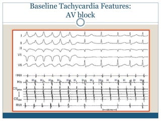 Baseline Tachycardia Features:
AV block
 