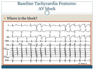Baseline Tachycardia Features:
AV block
 Where is the block?
 