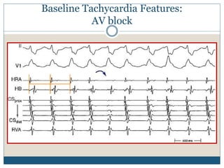 Baseline Tachycardia Features:
AV block
 