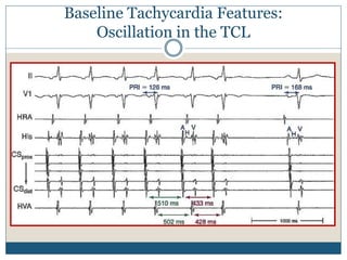 Baseline Tachycardia Features:
Oscillation in the TCL
 