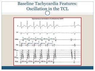 Baseline Tachycardia Features:
Oscillation in the TCL
 