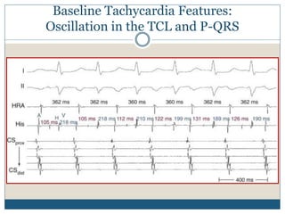 Baseline Tachycardia Features:
Oscillation in the TCL and P-QRS
 