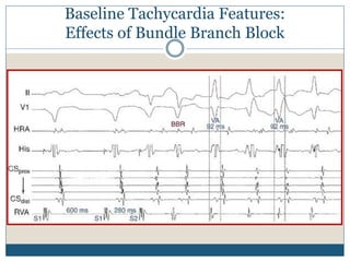 Baseline Tachycardia Features:
Effects of Bundle Branch Block
 