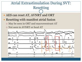 Atrial Extrastimulation During SVT:
Resetting
 AES can reset AT, AVNRT and ORT
 Resetting with manifest atrial fusion
 May be seen in ORT and macroreentrant AT
 Not seen in AVNRT or focal AT
 