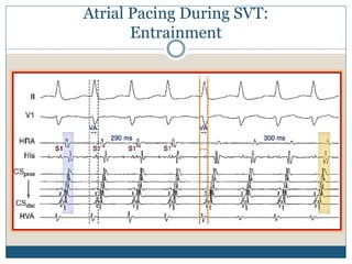 Atrial Pacing During SVT:
Entrainment
 