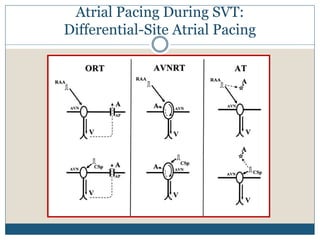 Atrial Pacing During SVT:
Differential-Site Atrial Pacing
 