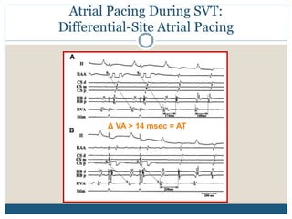 Atrial Pacing During SVT:
Differential-Site Atrial Pacing
Δ VA > 14 msec = AT
 