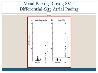 Atrial Pacing During SVT:
Differential-Site Atrial Pacing
 