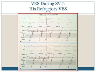 VES During SVT:
His Refractory VES
 