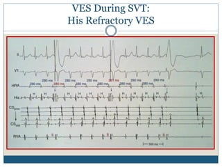 VES During SVT:
His Refractory VES
 