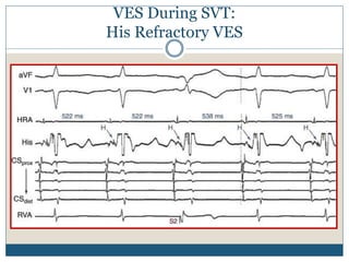 VES During SVT:
His Refractory VES
 