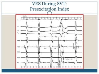 VES During SVT:
Preexcitation Index
 