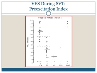 VES During SVT:
Preexcitation Index
 