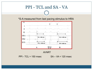 PPI - TCL and SA - VA
AVNRT
PPI - TCL = 150 msec SA – VA = 120 msec
*S-A measured from last pacing stimulus to HRA
 