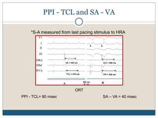 PPI - TCL and SA - VA
ORT
PPI - TCL= 80 msec SA – VA = 40 msec
*S-A measured from last pacing stimulus to HRA
 
