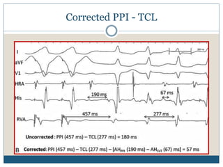 Corrected PPI - TCL
 