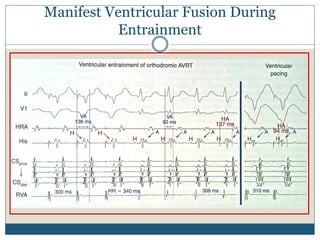 Manifest Ventricular Fusion During
Entrainment
 