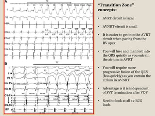 “Transition Zone”
concepts:
• AVRT circuit is large
• AVNRT circuit is small
• It is easier to get into the AVRT
circuit when pacing from the
RV apex
• You will fuse and manifest into
the QRS quickly as you entrain
the atrium in AVRT
• You will require more
progressive fusion of the QRS
(less quickly) as you entrain the
atrium in AVNRT
• Advantage is it is independent
of SVT termination after VOP
• Need to look at all 12 ECG
leads
 